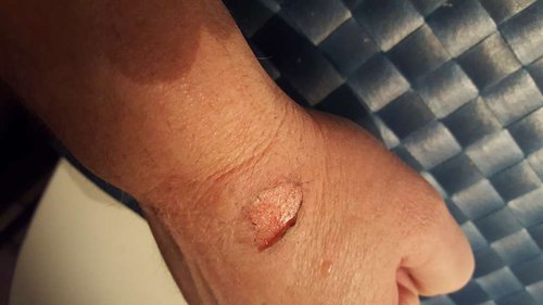 14.01 morgen, før hospital.jpg (38.06 KiB) Vist 5828 gange Sådan så det ud, da jeg spiste morgenmad. Da jeg opdagede de røde streger måtte jeg ringe 1813.